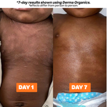 Eczema + Psoriasis + TSW Relief Duo