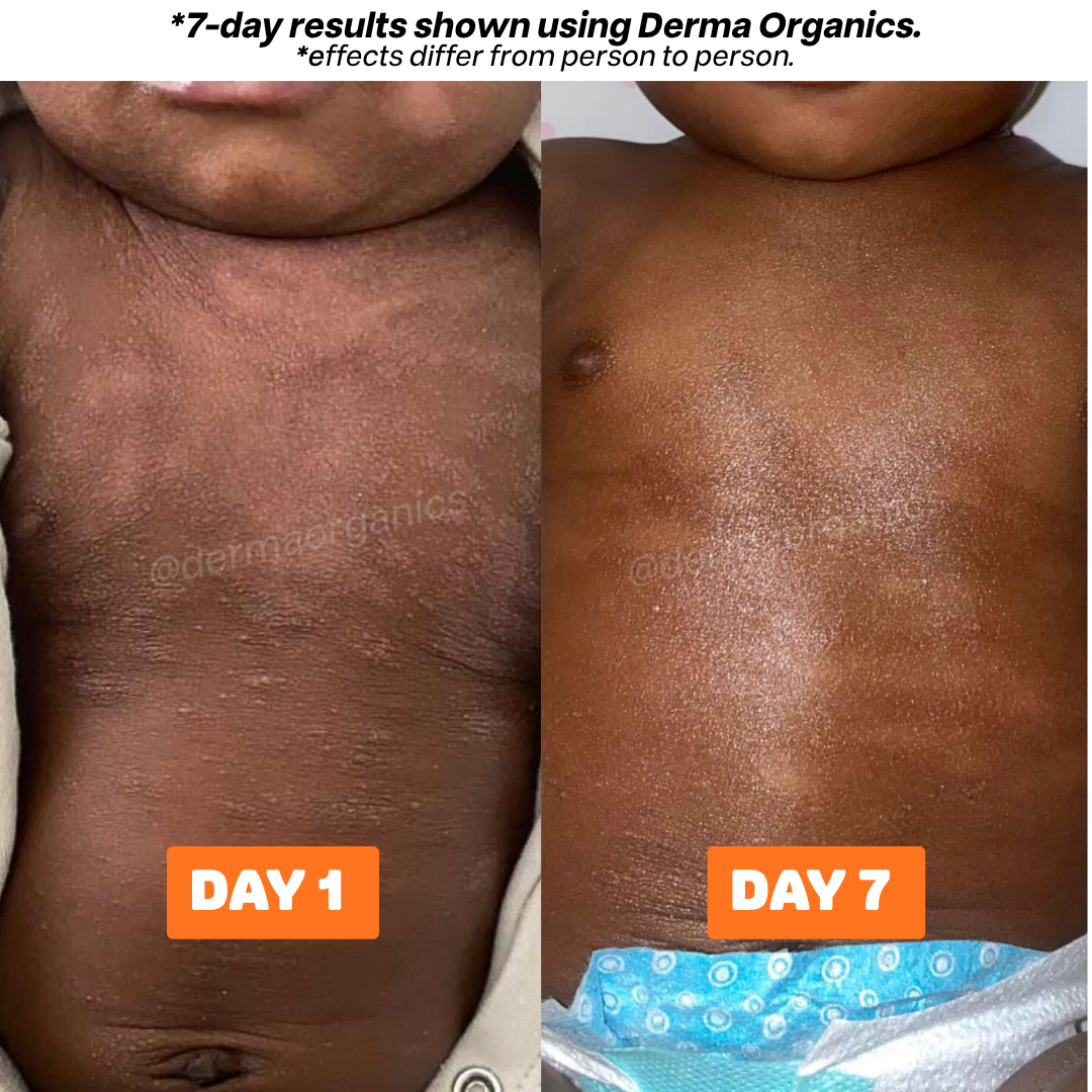 Eczema + Psoriasis + TSW Relief Duo