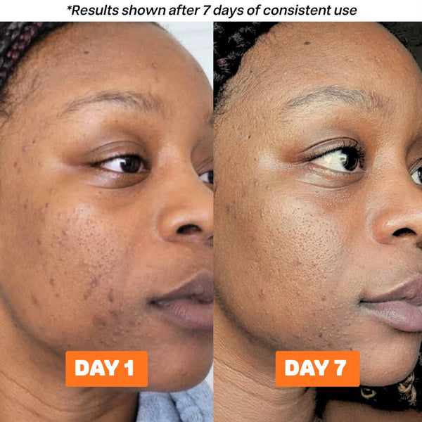 The Acne Buster Package alternate view