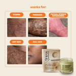 Eczema + Psoriasis + TSW Relief Duo