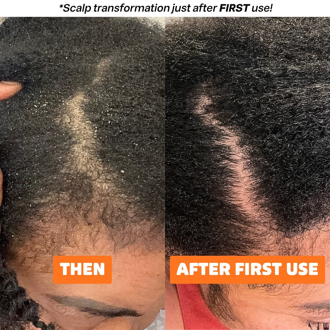 Scalp Stimulating Treatment