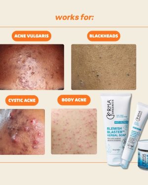 acne-2