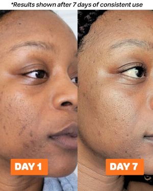 acne-buster