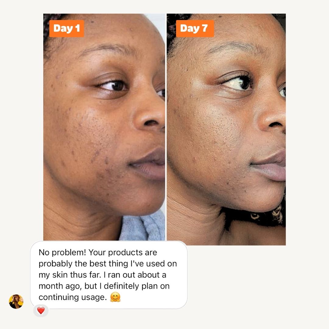 Acne Buster Package