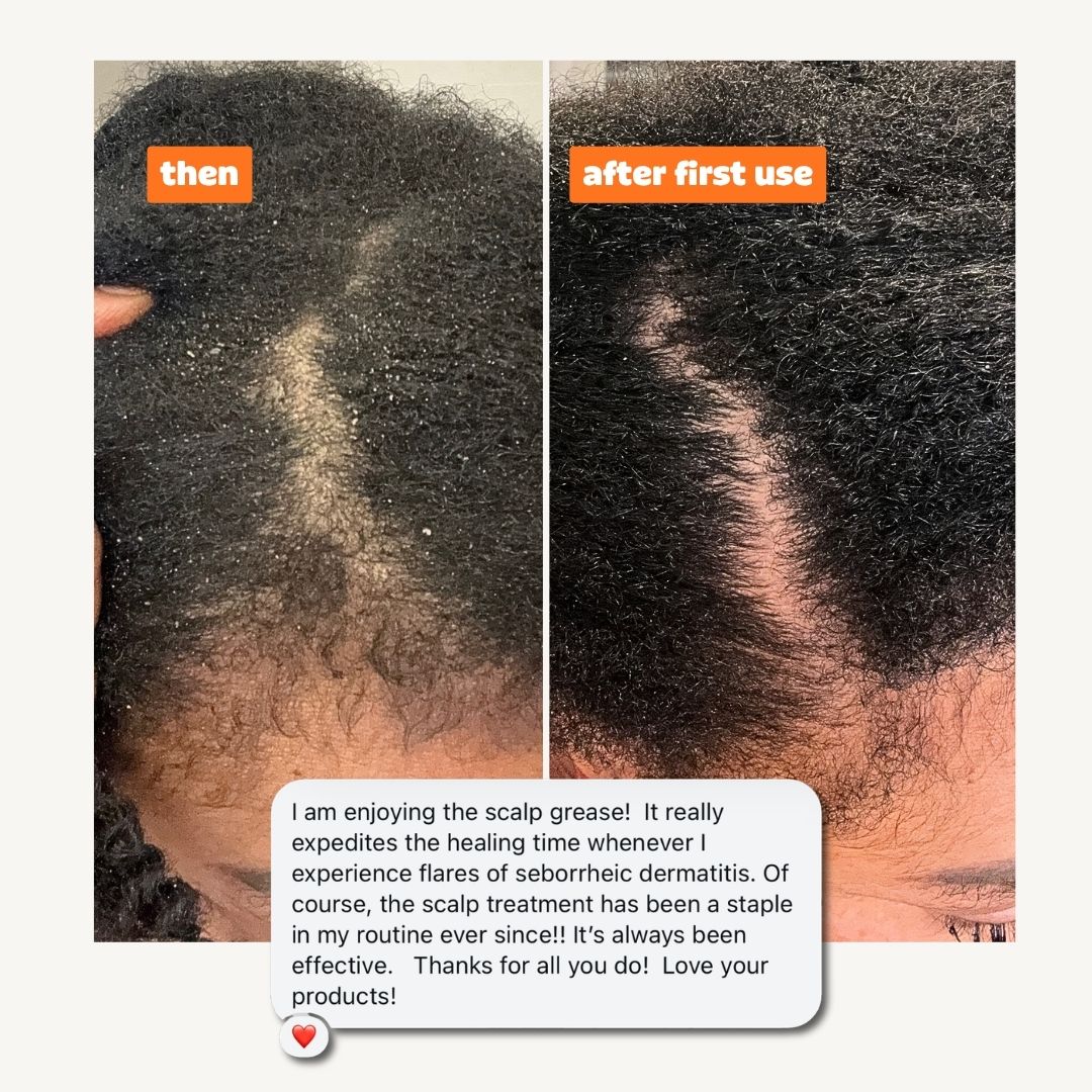 Seborrheic Dermatitis + Psoriasis Relief Bundle (1)