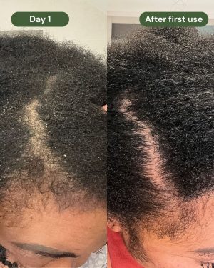 scalp-relief-4